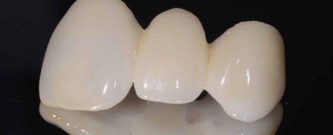 All ceramic bridge
