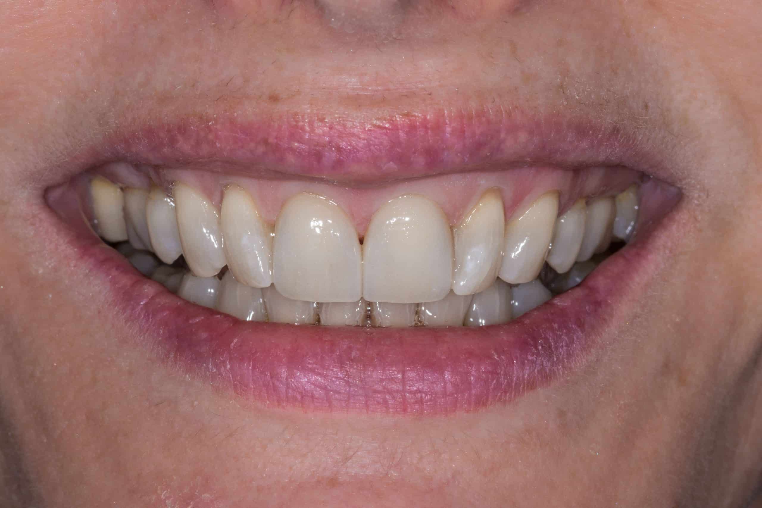 Two front teeth-3