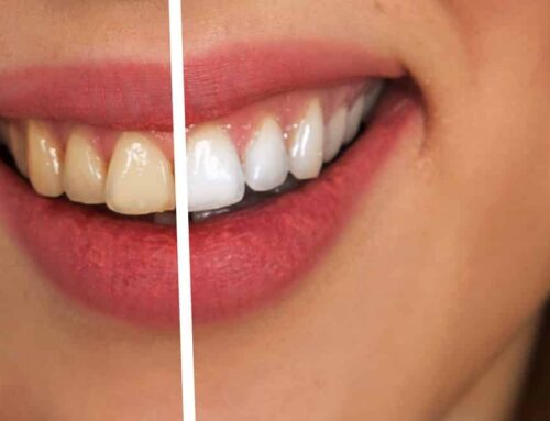 Looking for a Teeth Whitening Specialist in Melbourne?