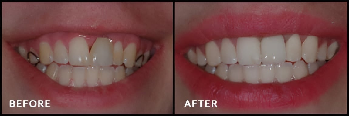 Implant-Retained-Crowns-1-min-Picsart-AiImageEnhancer