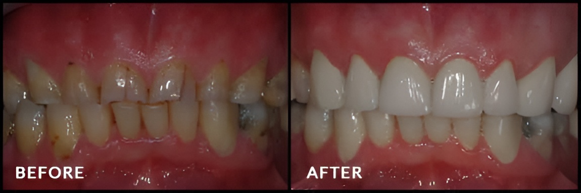 Treatment-of-severe-tooth