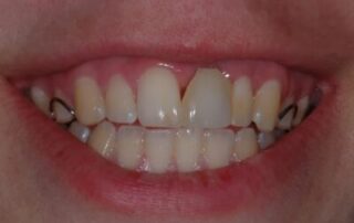 G2.1.1.1_Implant_Retained_Crown_B-n9x2mi3my65wa5rnlaklnij34zr3bey44td4zri61m-min-400×274