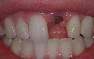 G2.1.1.2_Implant_Retained_Crown-n9x2nb8mu19sa2lbv561at6djxrgy15sktl6vcayoq-min-400×274
