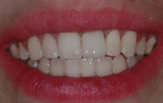 G2.1.1.3_Implant_Retained_Crown_A-n9x2ll7aaywuzt3fxecnq8tyci98u0bicaj572uy3e-min-400×274