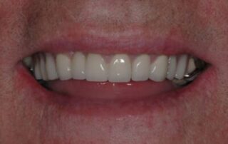 G2.2.1.2_Partial_Denture_A-n9wxt7ksyqxtu7hghvxpgqssinvz89zlz3jiuag36i-min-400×274