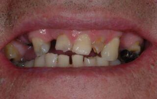 Partial-Dentures Case