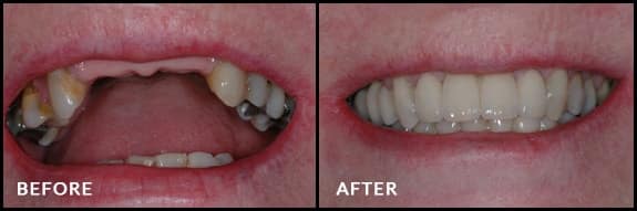 Partial-implant-retained-fixed-bridges-1-1-min