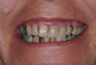all-on-four-image-5-400×274