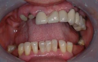 full-implant-retained-fixed-bridges-image-1-400×274