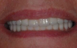 full-implant-retained-fixed-bridges-image-2-400×274