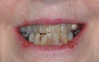 implant-retained-removable-dentures-image-1-400×274