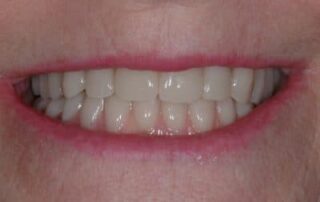 implant-retained-removable-dentures-image-2-400×274