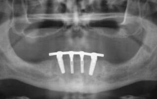 implant-retained-removable-dentures-image-3-400×274