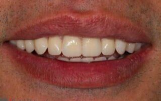 implant-retained-removable-dentures-image-5-400×274